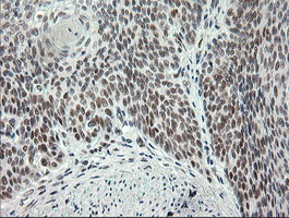 ERCC1 Antibody - Immunohistochemical staining of paraffin-embedded Carcinoma of Human bladder tissue using anti-ERCC1 mouse monoclonal antibody. (Clone 2E12, dilution 1:100; heat-induced epitope retrieval by 10mM citric buffer, pH6.0, 120C for 3min)