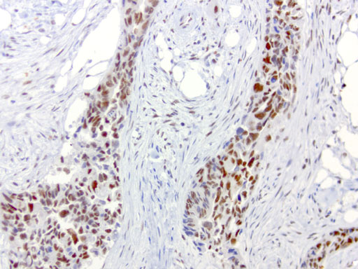 ERCC1 Antibody - Immunohistochemical staining of FFPE endometrial carcinoma using heat-induced epitope retrieval HIER at 120C for 3min with Accel buffer pH8.7, mouse monoclonal antibody anti-ERCC1 clone 4F9 was used at 1ug/mL. Strong nuclear stain in tumor cells.