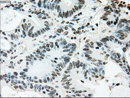 ERCC1 Antibody - Immunohistochemical staining of paraffin-embedded Adenocarcinoma of colon tissue using anti-ERCC1 mouse monoclonal antibody. (Dilution 1:50).