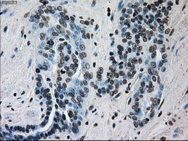 ERCC1 Antibody - Immunohistochemical staining of paraffin-embedded Adenocarcinoma of ovary tissue using anti-ERCC1 mouse monoclonal antibody. (Dilution 1:50).