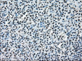 ERCC1 Antibody - Immunohistochemical staining of paraffin-embedded Carcinoma of pancreas tissue using anti-ERCC1 mouse monoclonal antibody. (Dilution 1:50).