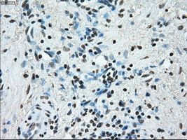 ERCC1 Antibody - Immunohistochemical staining of paraffin-embedded Adenocarcinoma of endometrium tissue using anti-ERCC1 mouse monoclonal antibody. (Dilution 1:50).