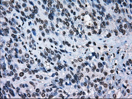 ERCC1 Antibody - Immunohistochemical staining of paraffin-embedded Carcinoma of bladder tissue using anti-ERCC1 mouse monoclonal antibody. (Dilution 1:50).