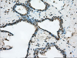 ERCC1 Antibody - Immunohistochemical staining of paraffin-embedded Carcinoma of prostate tissue using anti-ERCC1 mouse monoclonal antibody. (Dilution 1:50).