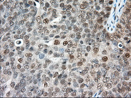 ERCC1 Antibody - Immunohistochemical staining of paraffin-embedded Adenocarcinoma of Human ovary tissue using anti-ERCC1 mouse monoclonal antibody. (Dilution 1:50).