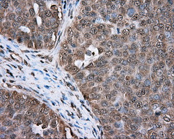ERCC1 Antibody - Immunohistochemical staining of paraffin-embedded Adenocarcinoma of ovary tissue N93ing anti-ERCC1 mouse monoclonal antibody. (Dilution 1:50).
