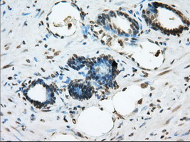 ERCC1 Antibody - Immunohistochemical staining of paraffin-embedded Carcinoma of prostate tissue using anti-ERCC1 mouse monoclonal antibody. (Dilution 1:50).