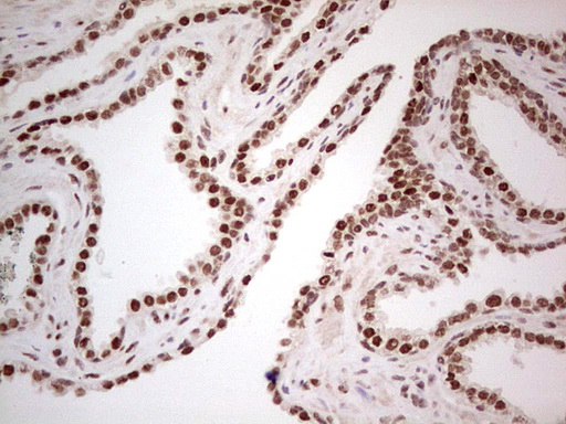 ERCC1 Antibody - Immunohistochemical staining of paraffin-embedded Carcinoma of Human pancreas tissue using anti-ERCC1 mouse monoclonal antibody. (Heat-induced epitope retrieval by 1 mM EDTA in 10mM Tris, pH8.5, 120C for 3min,