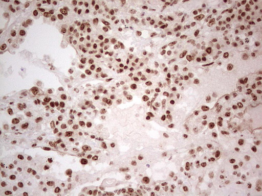 ERCC1 Antibody - Immunohistochemical staining of paraffin-embedded Adenocarcinoma of Human colon tissue using anti-ERCC1 mouse monoclonal antibody. (Heat-induced epitope retrieval by 1 mM EDTA in 10mM Tris, pH8.5, 120C for 3min,
