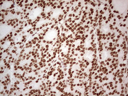 ERCC1 Antibody - IHC of paraffin-embedded Carcinoma of Human lung tissue using anti-ERCC1 mouse monoclonal antibody. (Heat-induced epitope retrieval by 1 mM EDTA in 10mM Tris, pH8.5, 120°C for 3min).