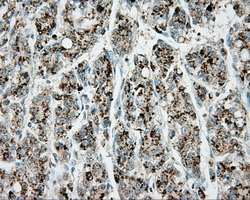 ERCC1 Antibody - Immunohistochemical staining of paraffin-embedded Carcinoma of liver tissue using anti-ERCC1 mouse monoclonal antibody. (Dilution 1:50).
