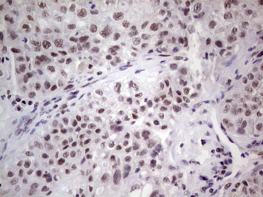 ERCC1 Antibody - Immunohistochemical staining of paraffin-embedded Carcinoma of Human lung tissue using anti-ERCC1 mouse monoclonal antibody. (Heat-induced epitope retrieval by 1 mM EDTA in 10mM Tris, pH8.5, 120C for 3min,