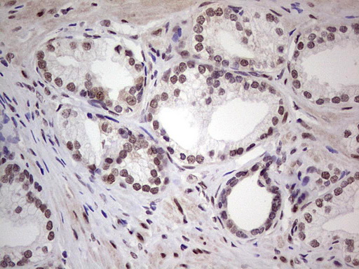 ERCC1 Antibody - Immunohistochemical staining of paraffin-embedded Human prostate tissue within the normal limits using anti-ERCC1 mouse monoclonal antibody. (Heat-induced epitope retrieval by 1 mM EDTA in 10mM Tris, pH8.5, 120C for 3min,