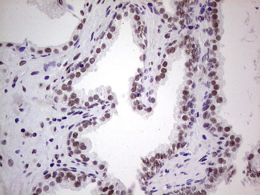 ERCC1 Antibody - Immunohistochemical staining of paraffin-embedded Carcinoma of Human prostate tissue using anti-ERCC1 mouse monoclonal antibody. (Heat-induced epitope retrieval by 1 mM EDTA in 10mM Tris, pH8.5, 120C for 3min,