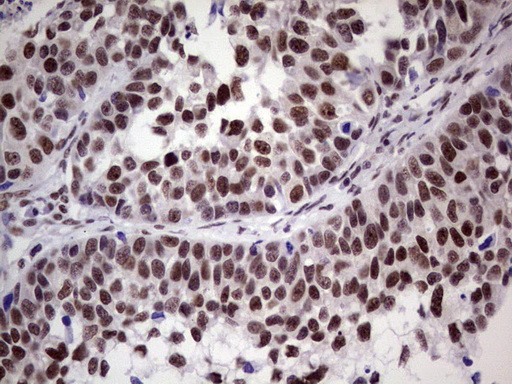 ERCC1 Antibody - IHC of paraffin-embedded Carcinoma of Human kidney tissue using anti-ERCC1 mouse monoclonal antibody. (Heat-induced epitope retrieval by 1 mM EDTA in 10mM Tris, pH8.5, 120°C for 3min).