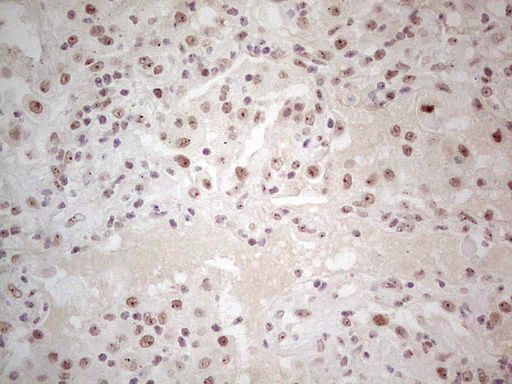 ERCC1 Antibody - IHC of paraffin-embedded Carcinoma of Human lung tissue using anti-ERCC1 mouse monoclonal antibody. (Heat-induced epitope retrieval by 1 mM EDTA in 10mM Tris, pH8.5, 120°C for 3min).
