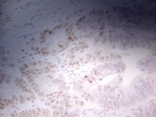 ERCC1 Antibody - Immunohistochemical staining of paraffin-embedded Adenocarcinoma of Human colon tissue using anti-ERCC1 mouse monoclonal antibody. (Heat-induced epitope retrieval by 1 mM EDTA in 10mM Tris, pH8.5, 120C for 3min,