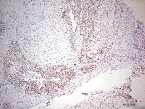 ERCC1 Antibody - Immunohistochemical staining of paraffin-embedded Carcinoma of Human kidney tissue using anti-ERCC1 mouse monoclonal antibody. (Heat-induced epitope retrieval by 1 mM EDTA in 10mM Tris, pH8.5, 120C for 3min,