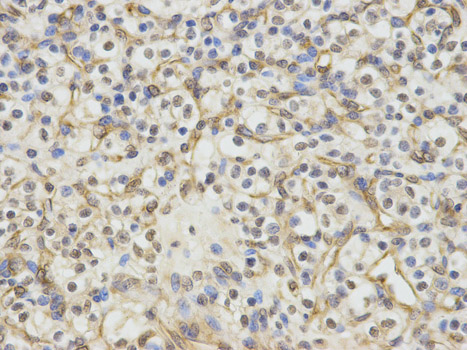 ERCC1 Antibody - Immunohistochemistry of paraffin-embedded human kidney cancer using ERCC1 antibody at dilution of 1:100 (400x lens).