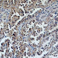 ERCC1 Antibody - Immunohistochemical analysis of ERCC1 staining in human lung cancer formalin fixed paraffin embedded tissue section. The section was pre-treated using heat mediated antigen retrieval with sodium citrate buffer (pH 6.0). The section was then incubated with the antibody at room temperature and detected using an HRP conjugated compact polymer system. DAB was used as the chromogen. The section was then counterstained with hematoxylin and mounted with DPX.