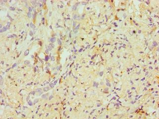 ERCC2 / XPD Antibody - Immunohistochemistry of paraffin-embedded human lung cancer using antibody at 1:100 dilution.