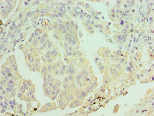 ERCC2 / XPD Antibody - Immunohistochemistry of paraffin-embedded human lung cancer using ERCC2 Antibody at dilution of 1:100