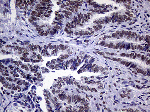 ERCC3 / XPB Antibody - Immunohistochemical staining of paraffin-embedded Adenocarcinoma of Human endometrium tissue using anti-ERCC3 mouse monoclonal antibody. (Heat-induced epitope retrieval by 1mM EDTA in 10mM Tris buffer. (pH8.5) at 120°C for 3 min. (1:1000)