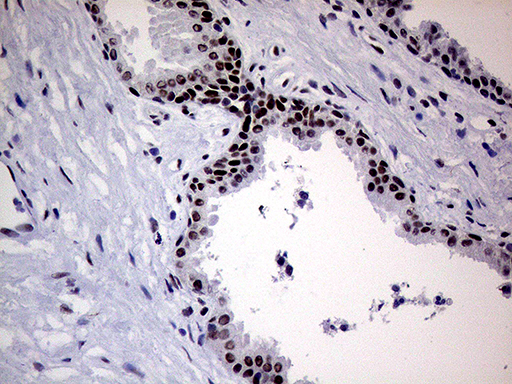 ERCC3 / XPB Antibody - Immunohistochemical staining of paraffin-embedded Carcinoma of Human prostate tissue using anti-ERCC3 mouse monoclonal antibody. (Heat-induced epitope retrieval by 1mM EDTA in 10mM Tris buffer. (pH8.5) at 120°C for 3 min. (1:1000)