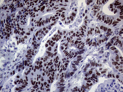 ERCC3 / XPB Antibody - Immunohistochemical staining of paraffin-embedded Adenocarcinoma of Human colon tissue using anti-ERCC3 mouse monoclonal antibody. (Heat-induced epitope retrieval by 1mM EDTA in 10mM Tris buffer. (pH8.5) at 120°C for 3 min. (1:1000)