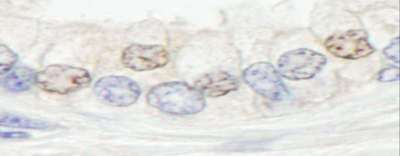 ERCC4 / XPF Antibody - Detection of Human XPF/ERCC4 by Immunohistochemistry. Sample: FFPE section of human prostate carcinoma. Antibody: Affinity purified rabbit anti-XPF/ERCC4 used at a dilution of 1:200 (1 ug/ml). Detection: DAB.