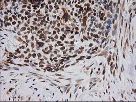 ERCC4 / XPF Antibody - IHC of paraffin-embedded Adenocarcinoma of Human breast tissue using anti-ERCC4 mouse monoclonal antibody.