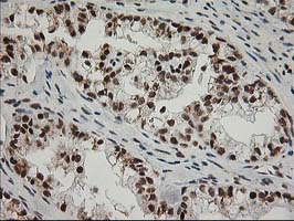 ERCC4 / XPF Antibody - IHC of paraffin-embedded Adenocarcinoma of Human ovary tissue using anti-ERCC4 mouse monoclonal antibody.