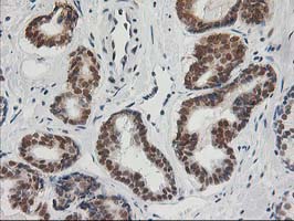 ERCC4 / XPF Antibody - IHC of paraffin-embedded Carcinoma of Human prostate tissue using anti-ERCC4 mouse monoclonal antibody.