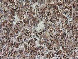 ERCC4 / XPF Antibody - IHC of paraffin-embedded Carcinoma of Human liver tissue using anti-ERCC4 mouse monoclonal antibody.