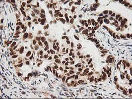ERCC4 / XPF Antibody - IHC of paraffin-embedded Carcinoma of Human lung tissue using anti-ERCC4 mouse monoclonal antibody.