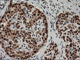 ERCC4 / XPF Antibody - IHC of paraffin-embedded Carcinoma of Human pancreas tissue using anti-ERCC4 mouse monoclonal antibody.