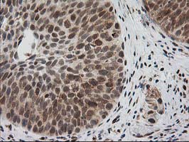 ERCC4 / XPF Antibody - IHC of paraffin-embedded Carcinoma of Human bladder tissue using anti-ERCC4 mouse monoclonal antibody.