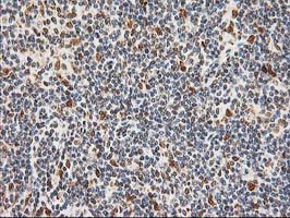 ERCC4 / XPF Antibody - IHC of paraffin-embedded Human lymphoma tissue using anti-ERCC4 mouse monoclonal antibody.
