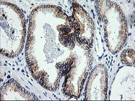 ERCC4 / XPF Antibody - IHC of paraffin-embedded Carcinoma of Human prostate tissue using anti-ERCC4 mouse monoclonal antibody.