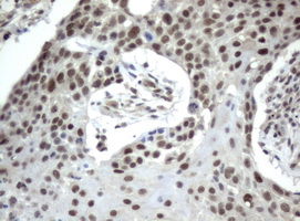 ERCC4 / XPF Antibody - Immunohistochemical staining of paraffin-embedded Carcinoma of lung tissue using anti-XPF. (UMAB20) mouse monoclonal antibody.  Dilution 1:50; heat-induced epitope retrieval by 10mM citric buffer, pH6.0, 120C for 3min)