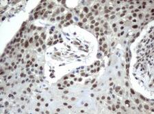 ERCC4 / XPF Antibody - Immunohistochemical staining of paraffin-embedded Carcinoma of lung tissue using anti-XPF. (UMAB20) mouse monoclonal antibody.  Dilution 1:50; heat-induced epitope retrieval by 10mM citric buffer, pH6.0, 120C for 3min)
