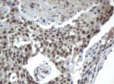 ERCC4 / XPF Antibody - Immunohistochemical staining of paraffin-embedded Carcinoma of lung tissue using anti-XPF. (UMAB21) mouse monoclonal antibody.  Dilution 1:50; heat-induced epitope retrieval by 10mM citric buffer, pH6.0, 120C for 3min)