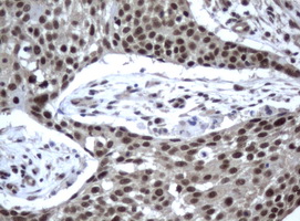 ERCC4 / XPF Antibody - Immunohistochemical staining of paraffin-embedded Carcinoma of lung tissue using anti-XPF. (UMAB22) mouse monoclonal antibody.  Dilution 1:50; heat-induced epitope retrieval by 10mM citric buffer, pH6.0, 120C for 3min)