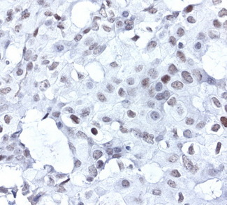 ERCC4 / XPF Antibody - Immunohistochemical staining of paraffin-embedded human breast cancer using anti-XPF clone UMAB20 mouse monoclonal antibody  1:50 with Polink2 Broad HRP DAB detection kit; heat-induced epitope retrieval with TEE pH9.0 HIER buffer using pressure chamber for 3 minutes at 110C. Nuclear staining is seen in the tumor cells.