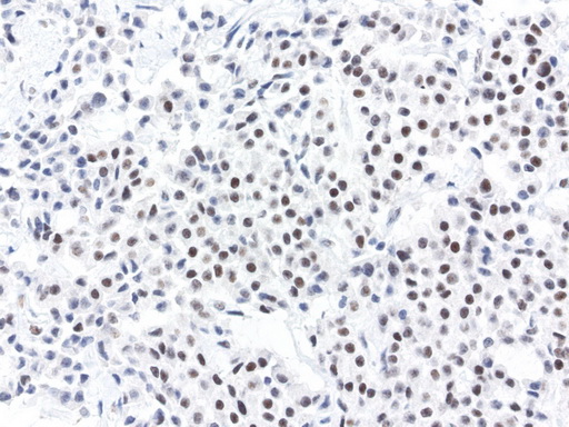 ERCC4 / XPF Antibody - Immunohistochemical staining of paraffin-embedded human lung cancer using anti-XPF clone UMAB20 mouse monoclonal antibody  1:50 with Polink2 Broad HRP DAB detection kit; heat-induced epitope retrieval with TEE pH9.0 HIER buffer using pressure chamber for 3 minutes at 110C. Nuclear staining is seen in the tumor cells.
