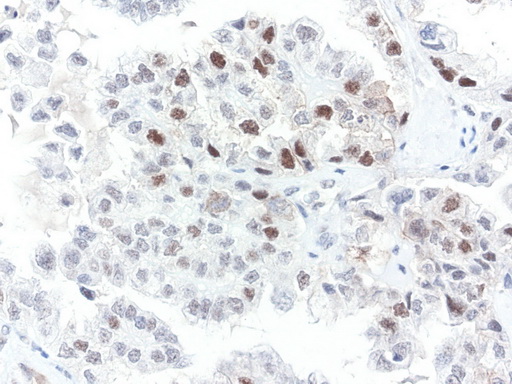 ERCC4 / XPF Antibody - Immunohistochemical staining of paraffin-embedded human ovarian cancer using anti-XPF clone UMAB20 mouse monoclonal antibody  1:50 with Polink2 Broad HRP DAB detection kit; heat-induced epitope retrieval with TEE pH9.0 HIER buffer using pressure chamber for 3 minutes at 110C. Nuclear staining is seen in the tumor cells.