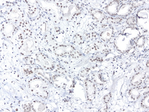 ERCC4 / XPF Antibody - Immunohistochemical staining of paraffin-embedded human prostate cancer using anti-XPF clone UMAB20 mouse monoclonal antibody  1:50 with Polink2 Broad HRP DAB detection kit; heat-induced epitope retrieval with TEE pH9.0 HIER buffer using pressure chamber for 3 minutes at 110C. Nuclear staining is seen in the tumor cells.