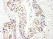 ERCC5 / XPG Antibody - Detection of Human ERCC5/XPG Immunohistochemistry. Sample: FFPE section of human ovarian carcinoma. Antibody: Affinity purified rabbit anti-ERCC5/XPG used at a dilution of 1:250.