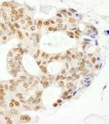 ERCC5 / XPG Antibody - Detection of Human ERCC5/XPG by Immunohistochemistry. Sample: FFPE section of human ovarian carcinoma. Antibody: Affinity purified rabbit anti-ERCC5/XPG used at a dilution of 1:200 (1 Detection: DAB.