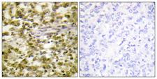 ERCC6 / CSB Antibody - Peptide - + Immunohistochemistry analysis of paraffin-embedded human breast carcinoma tissue, using ERCC6 antibody.